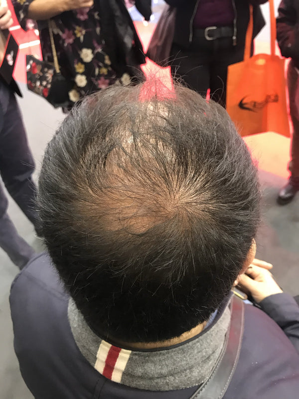Foto prima di applicare TOPPIK su capelli uomo